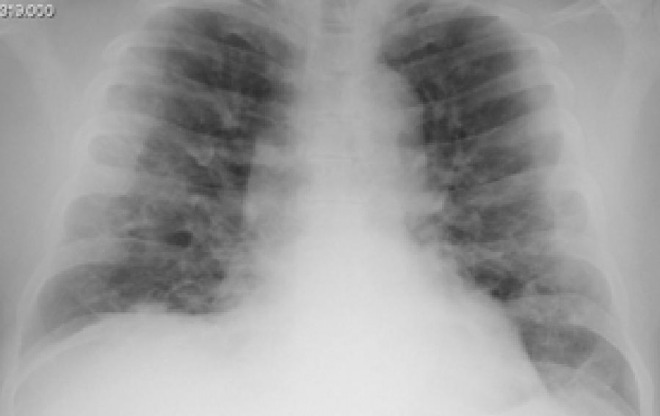一般的な肺炎は片側のみ⇒新型コロナだと両方の肺が肺炎に　医師「あまり両側の肺炎というのは無い」